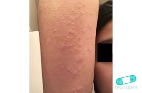 firstderm com wp content uploads queratosis pilari