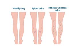 varicose veins symptoms and treatment