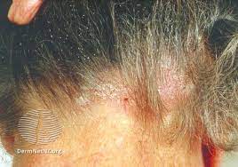 seborrhoeic dermais scalp the