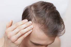 hair loss and ferritin deficiency