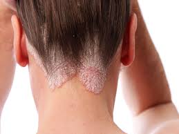 seborrheic dermais hair loss