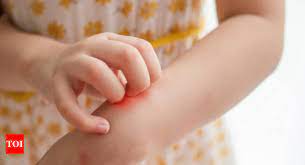 hives in children causes and care tips