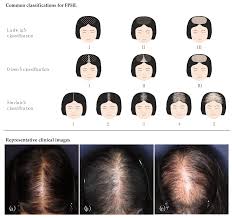 hair loss diseases
