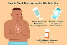 tinea versicolor treatment creams