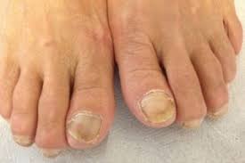 toenail fungus podiatrist peoria az
