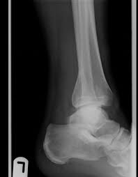 Maisonneuve fracture is a severe ankle injury which arises due to a spiral fracture of the proximal third of the fibula along with a tear of the distal tibiofibular syndesmosis and interosseous membrane. Report Of The Case Of A Rare Pattern Of Maisonneuve Fracture Sciencedirect