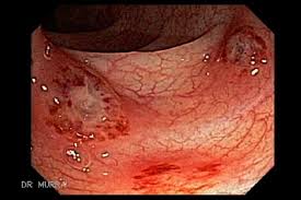Ulcerative colitis or uc is chronic inflammatory disease of the large treatment of colon cancer is surgery with removal of the cancerous tissue and/or polyps while treatment for ulcerative colitis depends upon the. Typhoid Ulcers El Salvador Atlas Of Gastrointestinal Video Endoscopy Gastrointestinalatlas Com
