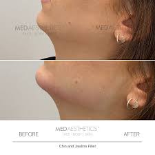 Dermal fillers are another option for people who want a more pronounced jawline, but don't want to undergo. Chin Jawline Fillers