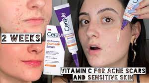 cerave vitamin c serum on my acne scars