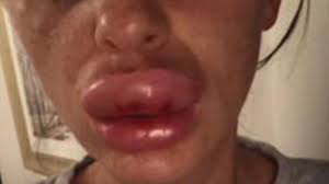 lip injection at botox party goes