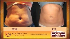 coolsculpting treatment with arizona midday red mounn weight loss