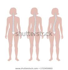 The human anatomy can remain a mystery to many, but by using our graphics you. Woman Scoliosis Flat Vector Illustration Types Of Scoliosis Of Spine Infographics Diagram With Spine Curvatures An In 2020 Human Body Drawing Body Drawing Human Body