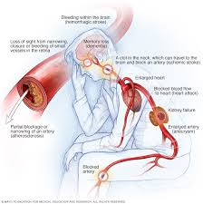 In 2014, high blood pressure was. High Blood Pressure Dangers Hypertension S Effects On Your Body Mayo Clinic