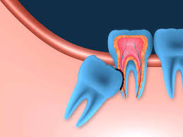 wisdom tooth extraction t32 dental