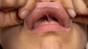 what is frenectomy all the things you