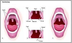 tonsillectomy procedure blood