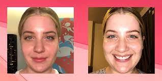 ipl laser for rosacea here s what