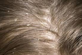 your scalp itches a day after washing