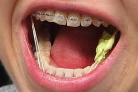 Soft breads are fine, although the bread might get stuck in your braces. Wearing Braces What You Can Can Not Eat Schmitt Orthodontics