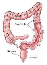 Diverticulosis Diverticulitis Cleveland Clinic