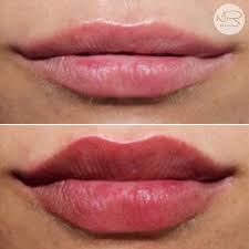 dissolving lip fillers dr nyla