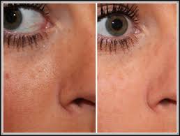 large pores clinique pore minimizer