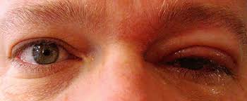 shingles in the eye symptoms causes