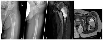 pathologic proximal fem fracture