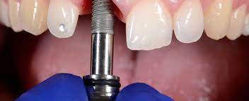 cost of two front teeth implants in india