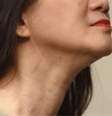 Cancer in the lymph nodes is known as lymph node cancer. Swollen Neck Glands May Indicate Cancer