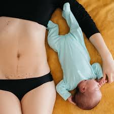 c section scars types care and healing
