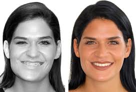 If your overbite is severe, ask us how to fix overbite with our surgery. Dysgnathia Dr Dr Kater Facial Asymmetries