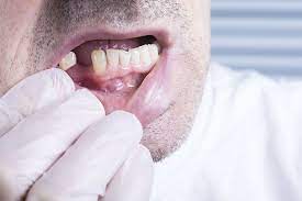 signs your tooth needs to be extracted