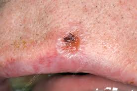 basal cell carcinoma on the lip stock
