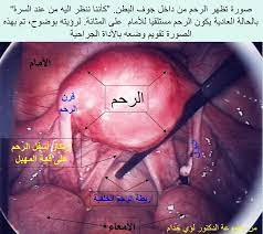 الرحم الولادة تنظيف بعد تنظيف الرحم