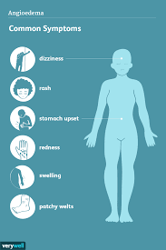 symptoms of angioedema