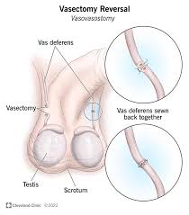Vasectomy Reversal: Purpose, Procedure & Success Rate