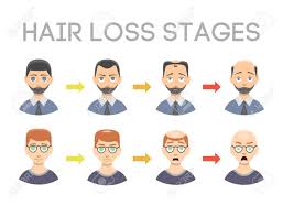 Information Chart Of Hair Loss Stages Types Of Baldness Illustrated