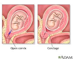 cervical insufficiency