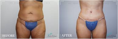 tummy tuck st louis cosmetic surgery