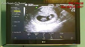 Lalu bagaimana ya sebetulnya perkembangan janin di usia ini? Usg Janin 3 Bulan Usg 2d At 10w2d Sat July 29 2017 Baby Moves 1st Pregnancy 2 Youtube