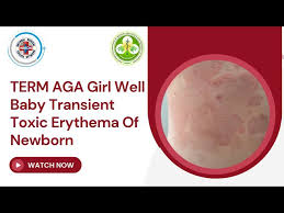 term aga well baby transient toxic