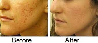 home remes to remove deep acne scars