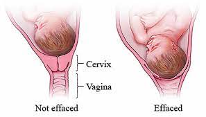 cervical effacement cervix thinning