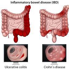 Final report on a therapeutic trial. Why Clinical Remission Is Not The Goal In Ibd