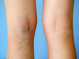 how to hide your varicose spider veins