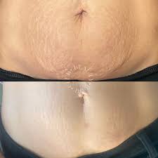 inkless stretch mark removal