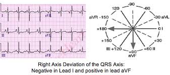 Determine Axis On A 12 Lead Ecg Tracing Learntheheart Com