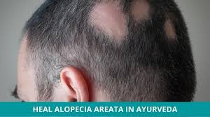 how to heal alopecia areata in ayurveda