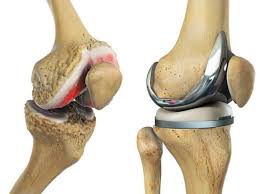 total knee replacement recovery what